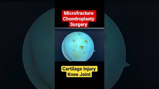 CARTILAGE INJURY KNEE JOINT microfracture chondroplasty surgery  doctor in Jaipur [upl. by Schild]