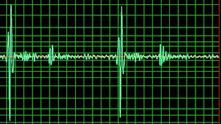 Aortic Regurgitation Ejection Systolic Murmur slow [upl. by Andromede]