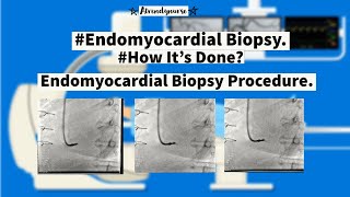 what is Endomyocardial Biopsy How Its Done Endomyocardial Biopsy Procedure [upl. by Frendel]