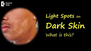 LIGHT SPOTS amp PATCHES ON BROWN OR DARK SKIN Causes amp Treatment  DrNischal K  Doctors Circle [upl. by Brelje]