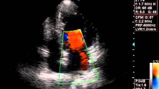 myxomatous degeneration of the mitral valve resulting in regurgitation [upl. by Iaverne]