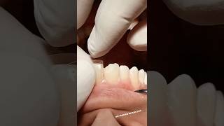 Class IV composite restoration dentist satisfying [upl. by Ylnevaeh628]