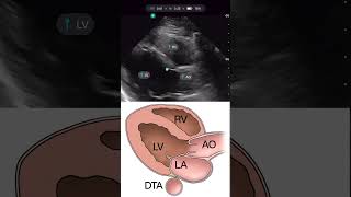 Parasternal Long Axis with Handheld Ultrasound Exo Iris® [upl. by Aicekat683]