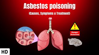 Asbestos Poisoning Causes Symptoms and Treatment [upl. by Ynneh85]