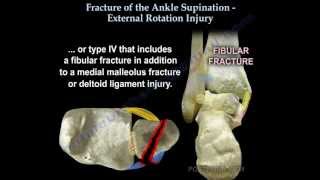 Ankle fracture  Supination External Rotation  Everything You Need To Know  Dr Nabil Ebraheim [upl. by Keheley914]