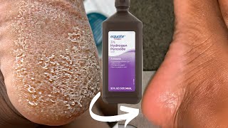 TRY HYDROGEN PEROXIDE ON YOUR FEET AND SEE WHAT HAPPENS Shocking [upl. by Elvia678]