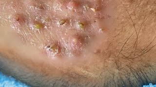 Big Cystic Acne Blackheads Extraction Blackheads amp Milia Whiteheads Removal Pimple Popping 059 [upl. by Ltsyrk]