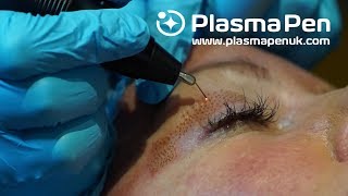 Plasma Pen NonSurgical Blepharoplasty 2 [upl. by Everrs374]