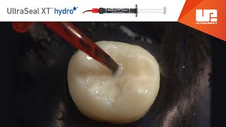 Video de procedimiento de UltraSeal XT hydro de Ultradent [upl. by Yennek]