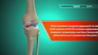 Osteotomy Animation i [upl. by Yedoc]