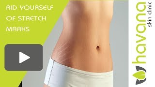 HOW TO GET RID OF YOUR STRETCH MARKS  POST PREGNANCY STRETCH MARKS TREATMENT [upl. by Diamond]