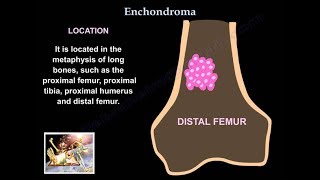 Enchondroma  Everything You Need To Know  Dr Nabil Ebraheim [upl. by Anilegnave]