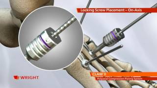 CLAW™ II Polyaxial Compression Plating Animation [upl. by Lyrak213]