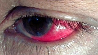 RED EYE  Top 10 Causes symptoms signs and treatment redeye pinkeye treatmentofredeyes [upl. by Plato319]