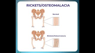 What is the Vitamin Deficiency in Osteomalacia Vitamin D Deficiency [upl. by Icken]