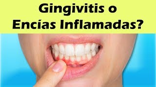 COMO CURAR LA GINGIVITIS Remedios Caseros Para La Gingivitis y Encías Inflamadas [upl. by Kubetz264]