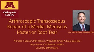 Arthroscopic Transosseous Repair of a Medial Meniscal PosteriorRoot Tear Procedure Overview [upl. by Isdnil]