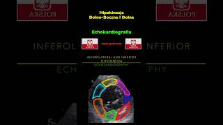 Echokardiografia  Hipokinezja DolnoBoczna I Dolna [upl. by Arerrac]