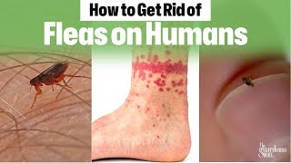 Ultimate Guide How to Get Rid of Fleas on Humans Fast [upl. by Letnoj]