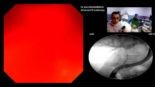 ERCP for hepatic duct neopalsic stricture [upl. by Millham]