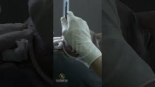 Hair Transplant Operation Saphhire FUEDHI hairtrasnplant hairtransplantsapphirefue nowhairtime [upl. by Anoi]