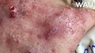 Squeeze acne  acne hidden under the skin  part 5 [upl. by Anirahc]