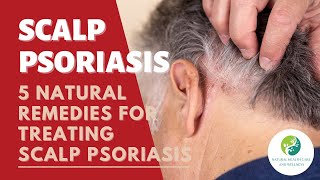 Scalp Psoriasis 5 Natural Remedies For Treating Scalp Psoriasis [upl. by Phonsa111]