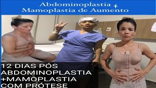 PÓS OPERATÓRIO ABDOMINOPLASTIA  MASTOPEXIA COM PRÓTESE mamoplastiadeaumento prótesedesilicone [upl. by Kallman32]