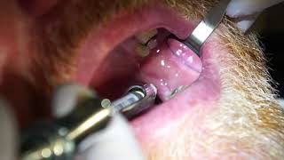 Inferior Alveolar IA Injection [upl. by Culhert]