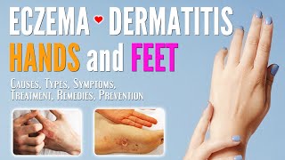 Eczema on Hands and Feet Causes Symptoms Types Treatment Remedies Prevention  Dermatitis treat [upl. by Nosiddam]