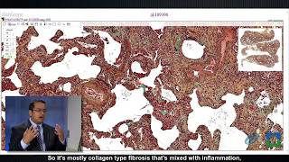 Pathology Insights Nonspecific Interstitial Pneumonia NSIP with Sanjay Mukhopadhyay MD [upl. by Pasahow497]