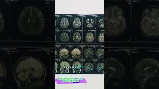 Decoding Brain MRI Understanding T1 and T2 W earlydetection digitalradiography cancerawareness [upl. by Adnole557]