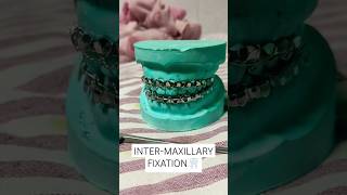 INTER MAXILLARY FIXATION [upl. by Wyatt]