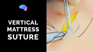 Vertical Mattress Suture  OSCE Guide  UKMLA  CPSA [upl. by Hplodnar572]