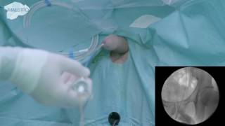 Access Sheath placement under fluoroscopy [upl. by Rebliw]