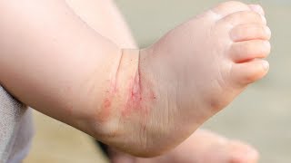 7 Tips to Manage Eczema Without Seeing a Dermatologist [upl. by Palocz130]