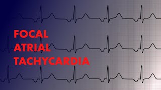 Focal Atrial Tachycardia  EKG Interpretation  MEDZCOOL [upl. by Aerbma]