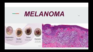 Malignant Melanoma Pathogenesis Morphology and Clinical picture [upl. by Kopple267]