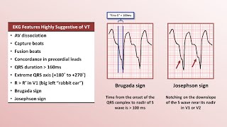 Advanced EKGs  Distinguishing VT from SVT with aberrancy [upl. by Anialad]