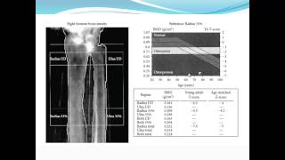 Bariatric Osteomalacia Fiona Cook MD  Internal Medicine Grand Rounds [upl. by Aleahs]