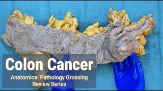 Colon Cancer  Anatomical Pathology Grossing Review Series [upl. by Gable753]