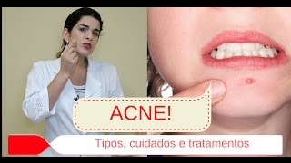 Acne espinhas  Causas Tipos Graus e passo a passo diário para tratar Patrícia Elias  Estética [upl. by Novahc512]