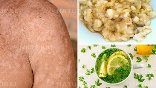 3 Natural Remedies for Treating Tinea Versicolor at Home Pityriasis Versicolor [upl. by Anec]