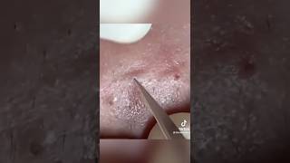 Élimination de Points Noirs Expressblackheads pimple acne [upl. by Cutlerr803]