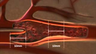 Carotid IMT educational video How the test is performed [upl. by Urial]