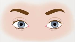 Animation of Left Upbeating Torsional Nystagmus seen in BPPV [upl. by Rodina]