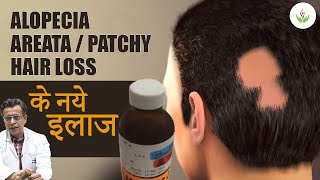 Alopecia Areata Treatment Patchy Hair Loss in 2024  गंजेपन का इलाज  Care Well Medical Centre [upl. by Ivets]