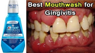 Top 3 Best Mouthwashes for Gingivitis Disease  Periodontal Disease [upl. by Gitt203]