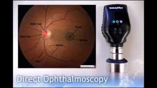 Direct Ophthalmoscopy [upl. by Stover]