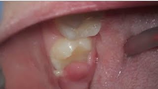 Whats this sore gum on wisdom tooth area explained  Management and treatmentpericoronitis [upl. by Mendelson]